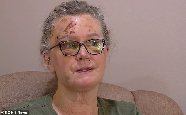 1715782472 579 Female hiker 63 shares terrible cuts and bruising after falling