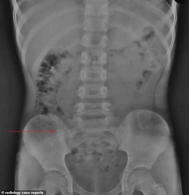 The boy was kept under observation for eight hours, was advised to drink plenty of fluids and was only allowed to eat a banana.  A second scan then showed that the pencil was near his ileocecal junction, a muscular valve that separates the small intestine and colon.