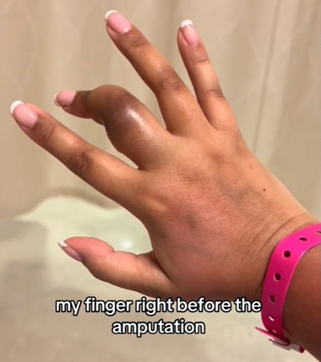 When they realized it was in fact a tumor, she had it removed, but within a month the tumor had grown back and doctors tried to remove it again.  The second time was less successful and the mother of two ended up having her finger completely removed