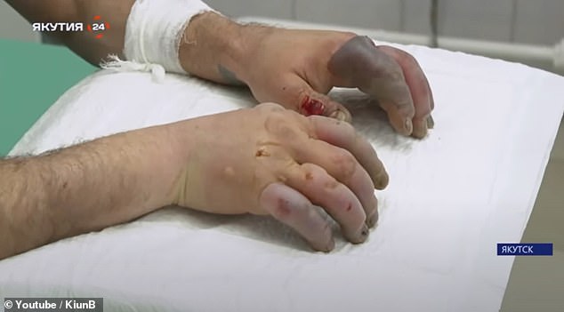 Kiun shows a series of rather gruesome video clips of local residents affected by severe frostbite on their fingers: 'Getting frostbite and hypothermia is almost as common as cold'