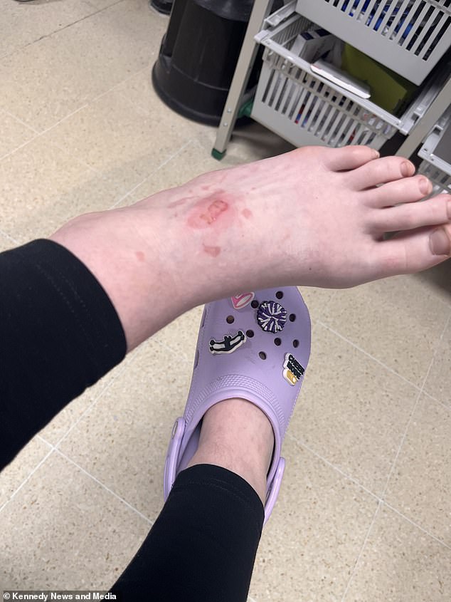 Insurance adviser Mrs Owen is grateful her daughter was not blinded by the scalding hot liquid and warns other parents about the viral craze (photo: some blisters on Sophie-Rose's foot)