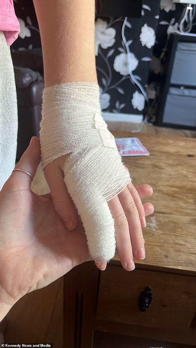 The mother of two immersed Sophie-Rose's foot and hand in cold water and noticed that huge blisters appeared on the child's skin (photo: the 12-year-old in bandages)