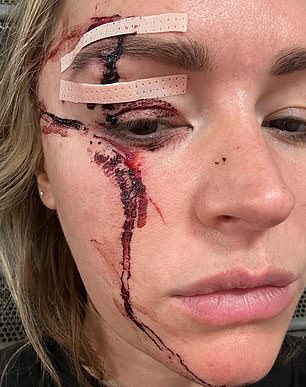 The TNT Sport presenter shared photos of her painful-looking injuries on social media