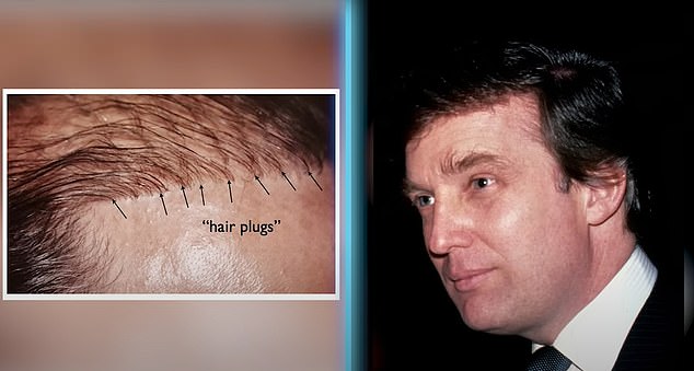 Dr.  Linkov also believes Trump has undergone plug grafts, a type of hair transplant in which surgeons take hair from the back of the head and transplant it into bald spots.