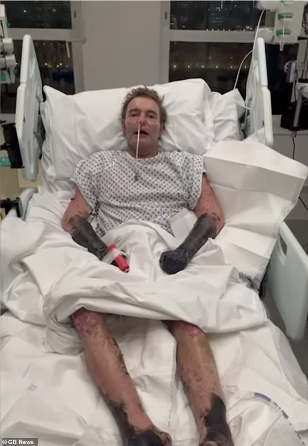 Craig Mackinlay pictured at St Thomas' Hospital on November 30 with blackened limbs after a sepsis