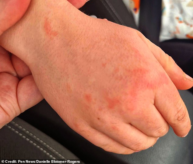 A red spot had developed on his hand – and by evening he had what looked like chickenpox on both arms
