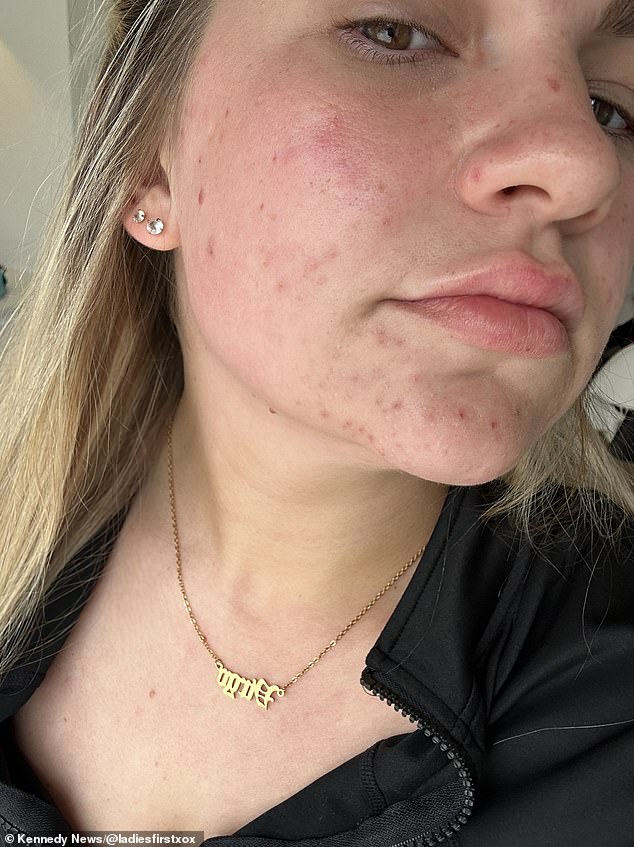 She said: 'I also started experiencing acne on the coil and this is not something I have suffered from before.'  After pleading with her GP again in April to remove the IUD, she agreed but told Ms Platt she needed to make an appointment, she claimed