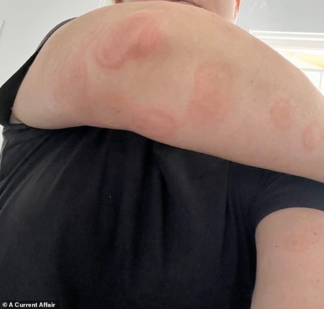 The family's vacation quickly turned sour when they discovered their beds were infested with bedbugs, leaving them with blistering red bites