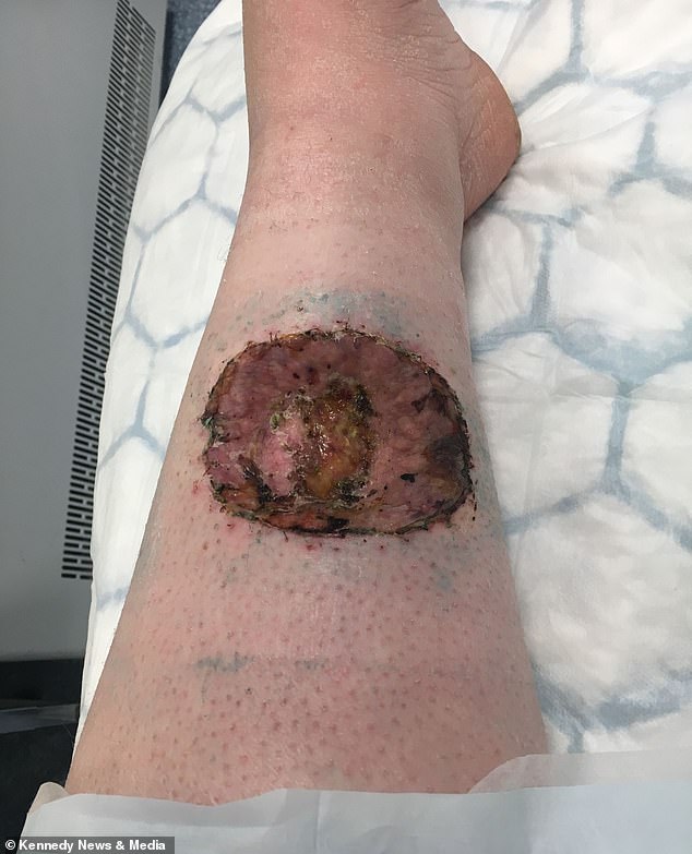 After two operations to remove the birthmark and surrounding skin from her leg, she required a skin graft to cover the incision, leaving the permanent 'crater' (pictured)