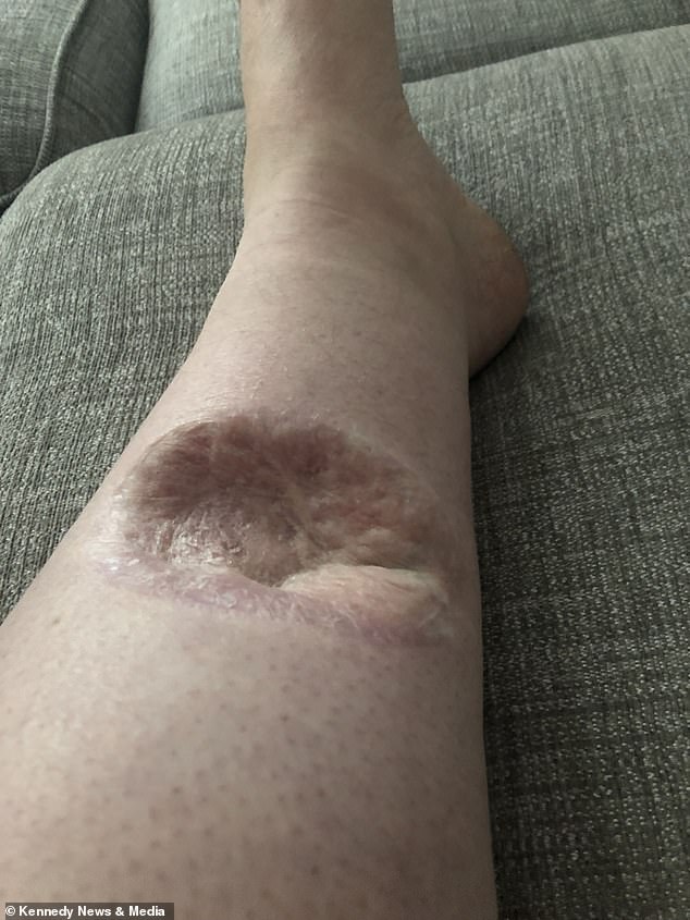 Mrs Grieves said: 'I've now had a skin graft put over it so it's healed, but I have a huge crater in my leg and it almost goes down to my bone.  When I knock, it's unbearable.'  She also never has bare legs in public again after commenting that 'kids are watching them'