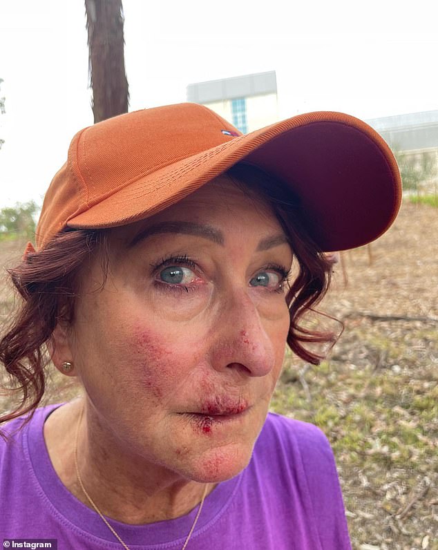 It comes after Lynne surprised fans last month sharing a photo of her bloodied and bruised face