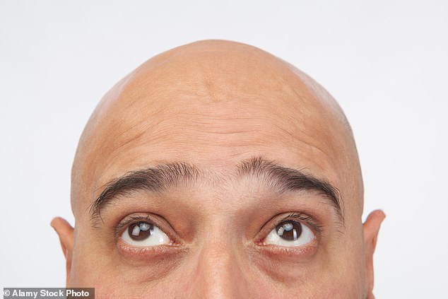 Will baldness become extinct?