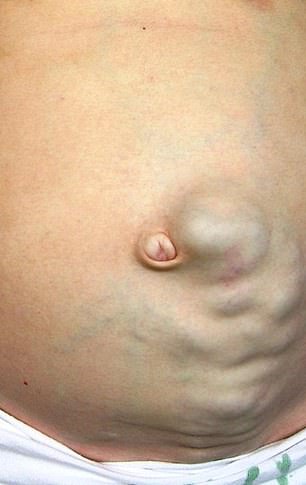 Medusa's head extending outward from the navel is usually a sign of advanced liver failure, known as cirrhosis