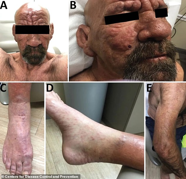 A 54-year-old man in central Florida (above) was diagnosed with lepromatous leprosy in 2022.  He sought treatment at a dermatology clinic for a painful and progressive rash