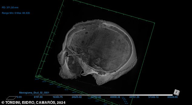 The researchers say studying skeletal remains poses certain challenges that make definitive statements difficult, especially because remains are often incomplete and there is no known clinical history.