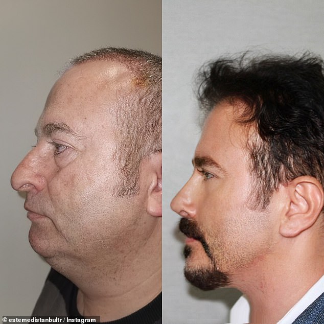 Dr.  Mikhail also believes that the patient underwent jaw surgery to achieve a more angular appearance, which is not mentioned in the Instagram post