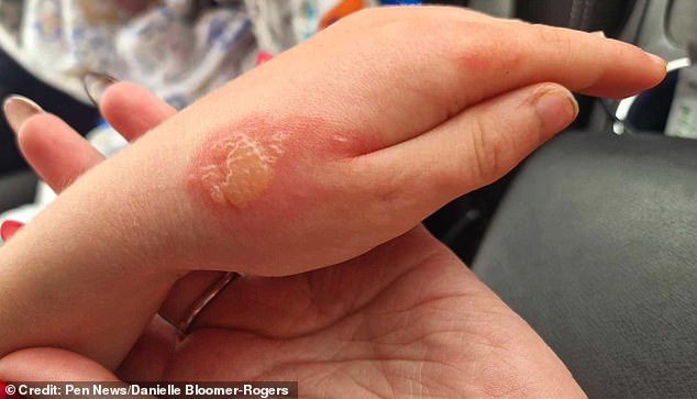 A schoolboy 'may never recover' after a scorching encounter with 'Britain's most dangerous plant' left him with second and third degree burns