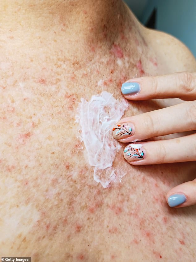 Itchy bumps on the skin can often be hives.  An emollient cream may be recommended by doctors, but the condition can often be misdiagnosed