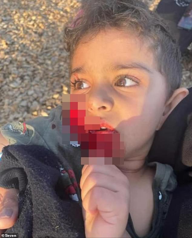 On Wednesday around 4:30 p.m., the three-year-old boy's skin was torn from his cheek and mouth by a 'loose dog'