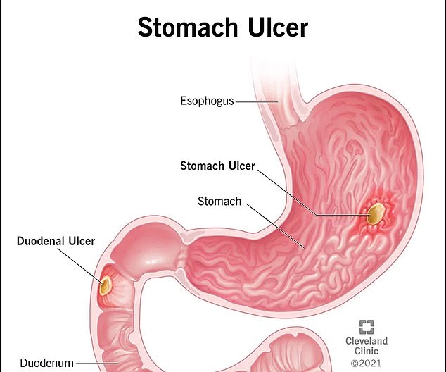 Stomach ulcers are small sores that develop on the lining of the stomach or small intestine and can cause a variety of gastrointestinal symptoms, from nausea and bloating to vomiting and dizziness.