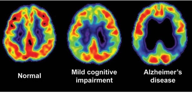 Among the thousands of donated brains collected in the study, researchers found that 12 people had signs of Alzheimer's disease in their brains, but no associated cognitive impairment.  Structural and chemical changes in the brain, such as cell death, affect a person's level of cognitive decline