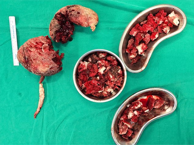 The above image shows the foam extracted from the man, on the left the imprint of the stomach and lower part of the esophagus can be seen on the foam