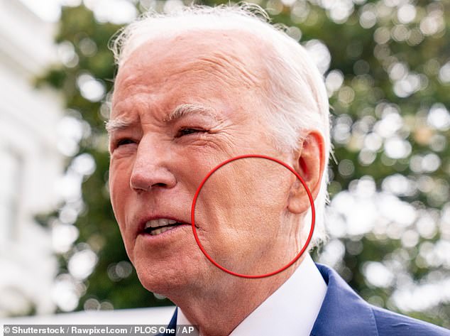 Biden is the oldest US president at 80 and was pictured last June with spots on his face (circled) consistent with using a CPAP machine