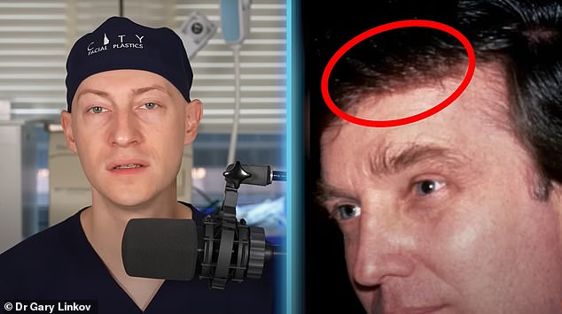 Plastic surgeon Dr. Gary Linkov (left) claimed in a YouTube video that he believed Trump had plug grafts, a type of hair transplant surgery.  Dr.  Linkov said: 'If you look closely you will see what appear to be small islands of hair.  I believe he may have had a procedure requiring plug transplants.”
