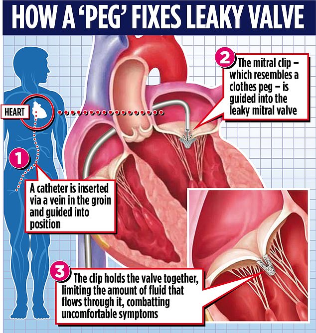 The remarkable surgery, called transcatheter edge-to-edge repair (TEER), inserts a thin tube, called a catheter, into a vein in the patient's groin to insert a small clip – like a clothespin – into the heart. conduct