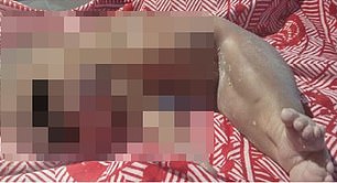 In an extremely rare case, a baby was born in Tanzania with its lower body fused together like a 'mermaid'