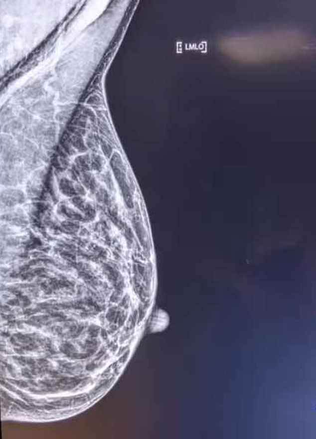 More than 8,000 women a year in the UK are diagnosed with lobular breast cancer, which rarely forms a lump and is extremely difficult to recognize in the early stages.  Pictured: A mammogram scan (file image)