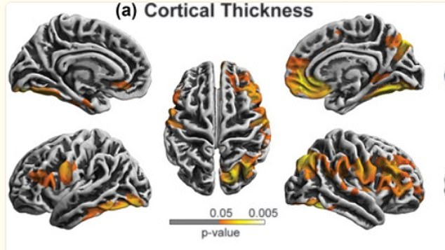 Areas lit in red and orange represent the choking group which had thicker brain areas in many regions, including parts of the frontal, temporal, parietal and occipital lobes, in both hemispheres involved in a long range of processes including facial recognition, decision-making.  making, self-awareness and motor movements