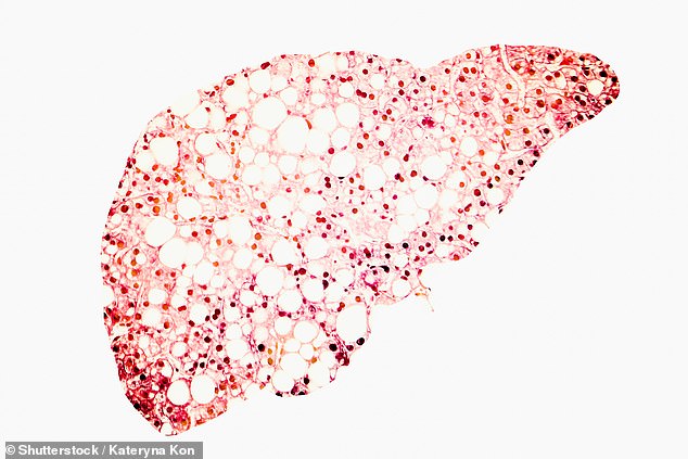 Growing evidence suggests that patients with NAFLD are at significant risk for coronary artery disease and irregular heartbeat (stock photo)