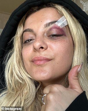 Rexha posted a video of her injuries on TikTok after the attack at her concert, which showed she required stitches