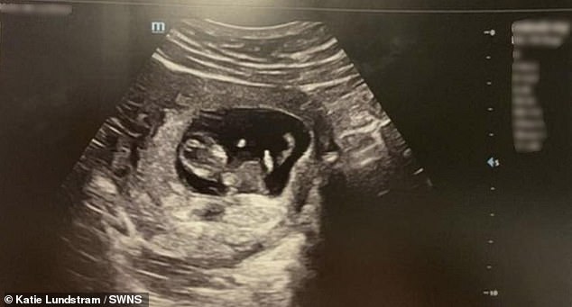 After being told the baby was small, Maddy decided to have a private 25-week scan to put her mind at ease.  During the scan, her daughter had raised two fingers