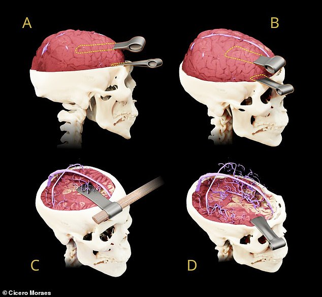 One of the weapons punctured the superior sagittal sinus, likely causing hemorrhage that led to Tao's last breaths (Image C)