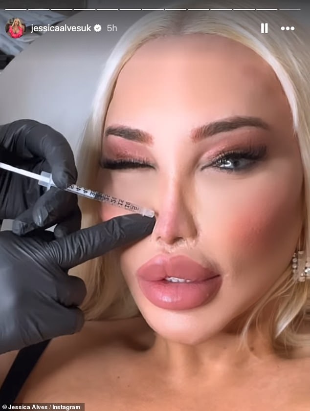 The reality star, who has had more than 100 procedures and spent more than £1 million on cosmetic surgery, had her Botox and hydraulic acid 'topped up' as she took to Instagram to document the procedure