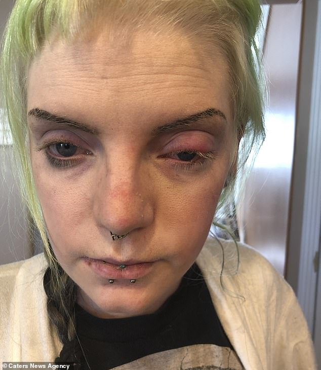 Alyssa Kelsch, 26, of Salt Lake City, Utah, was also diagnosed with the condition in 2018 after months of doctor appointments and specialist visits.  Pictured: The tattoo artist with glassy eyes during an episode where he felt 'drunk'