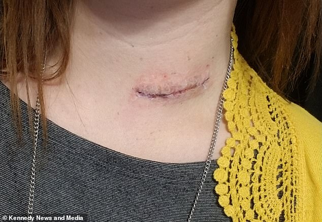 Jessica was left with a scar after the operation to remove the stringy hair stuck in her throat