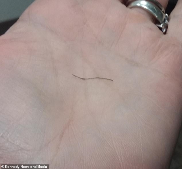 In the photo: the wire hair that was stuck in Jessica's throat for nine months