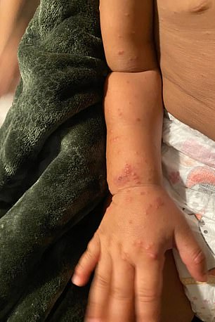 The one-year-old child also had bumps on his arm, which the mother initially dismissed as mosquito bites