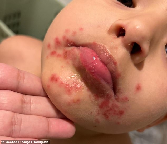 A five-year-old child named Javier also became infected with the disease after visiting a water park in San Antonio.  His symptoms are pictured above