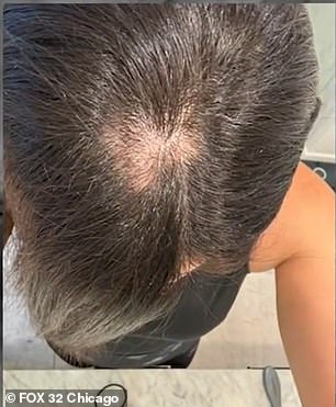 The 41-year-old was left with a bald spot