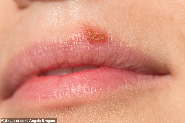 In adults, cold sores caused by the herpes simplex virus are not only common, but can also 'go away spontaneously' or be treated with antiviral creams