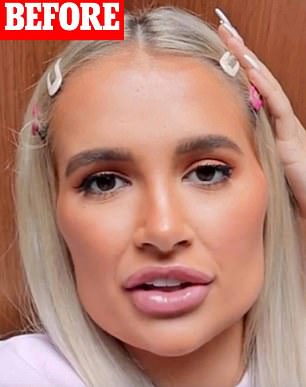 The former Love Island contestant, 25, has been documenting how her fillers were removed since 2020 (pictured in 2019)