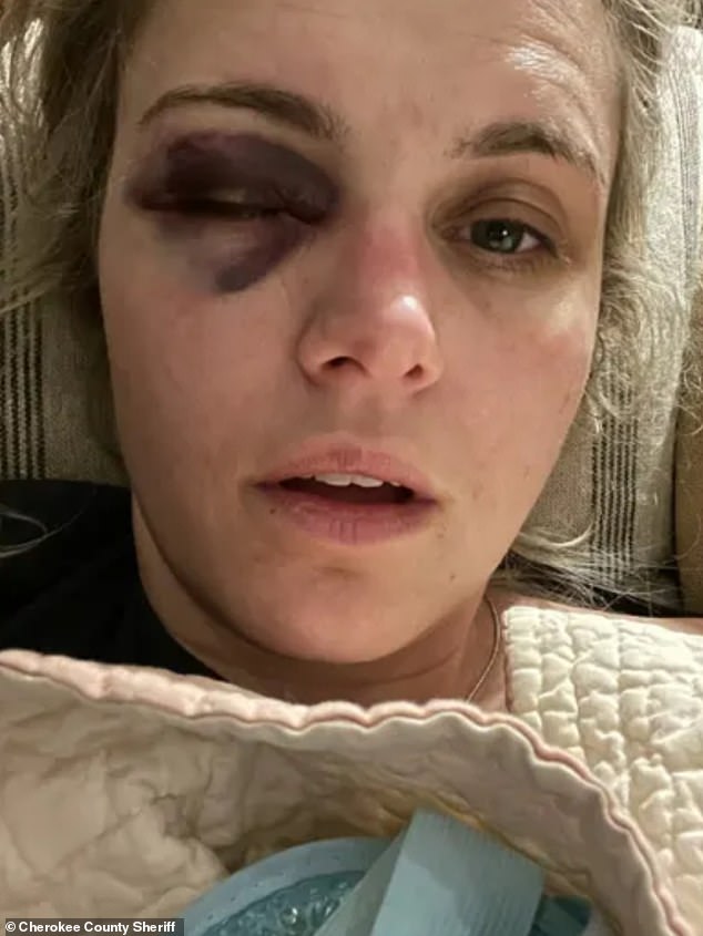 The Black Eye Morgan suffered from repeated beatings with the butt of a gun