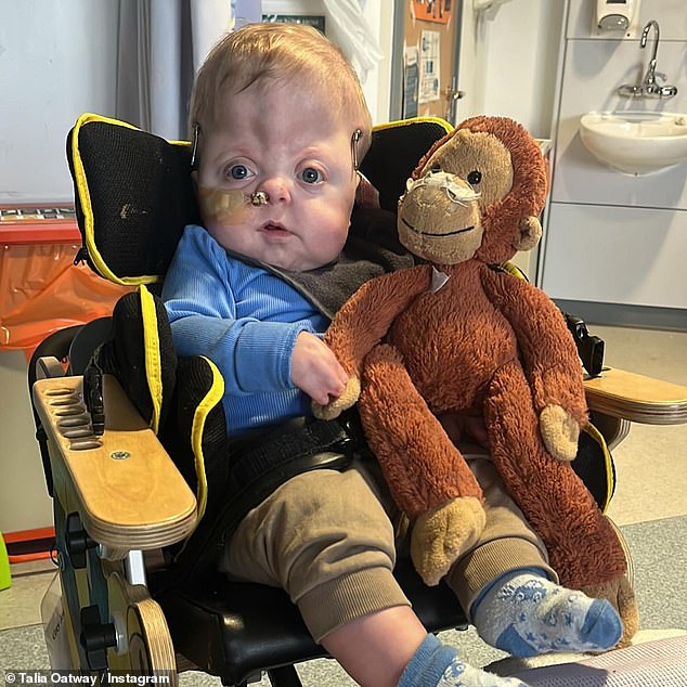 The NHS describes Apert syndrome as 'a type of complex craniosynostosis affecting the skull, hands and feet', where the bone fuses before birth