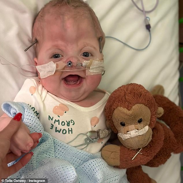 After keeping his diagnosis private, Talia explained that Oakley was born with Apert Syndrome, in a heartbreaking update shared this week