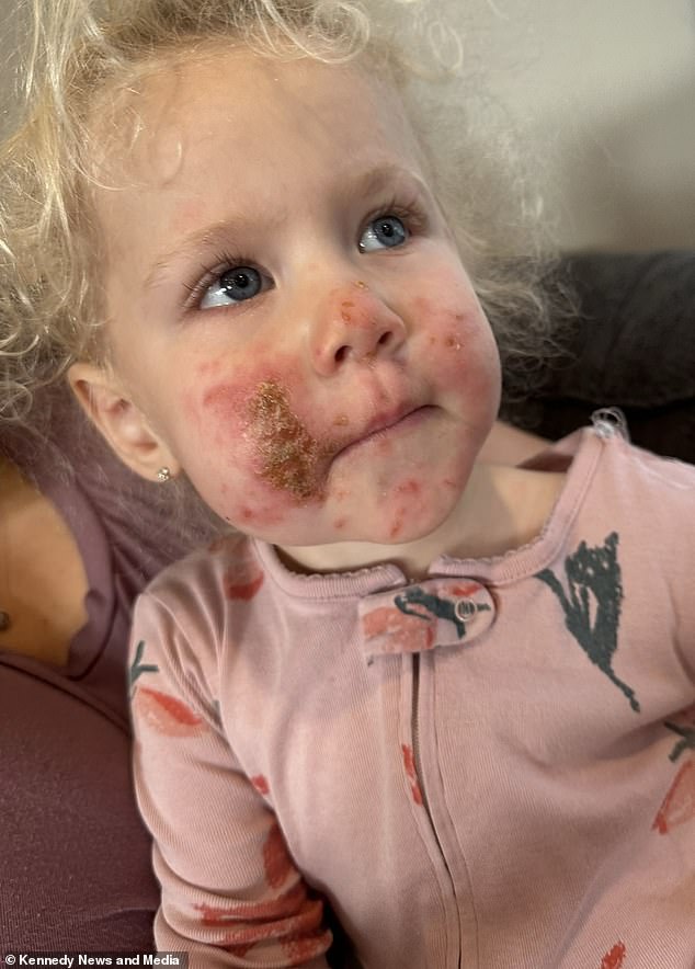 The curious toddler touched and smelled the stem of the wild parsnip plant, resulting in burns to her arms, face and legs