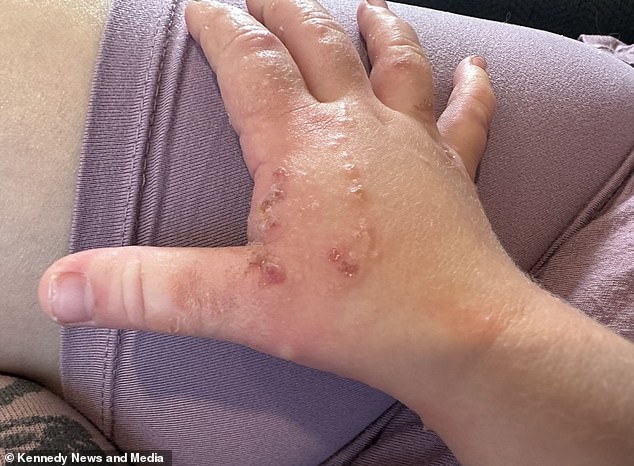 The burns required treatment with a topical steroid